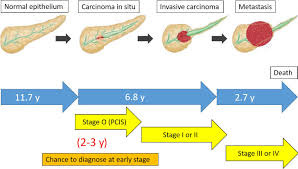 But as the cancer grows and spreads. Early Diagnosis Of Pancreatic Cancer Current Trends And Concerns Hanada 2017 Annals Of Gastroenterological Surgery Wiley Online Library