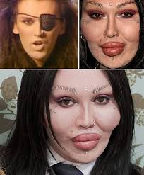 Do plastic surgeons elect to undergo cosmetic surgery more than the average american? Plastic Surgery Fails 8 Lip Enhancements Gone Wrong Oddee