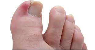 Si cela ne s'arrange pas rapidement consulter un médecin. Ongle Incarne Comment Traiter Sport Et Sante