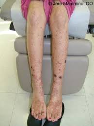 Immune thrombocytopenia may have no signs and symptoms. Henoch Schonlein Purpura American Osteopathic College Of Dermatology Aocd