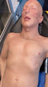 Image result for Flail Chest