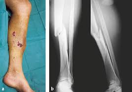 Image result for Open Fracture