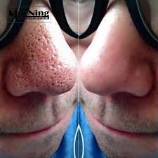 If you used a teapot, carefully pour the hot water into a deep pot or bowl. Blackhead Remover Nose Strips Black Mask 50pcs To Remove Acne Nose Black Heads Deep Cleaning