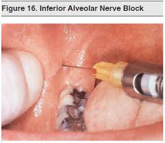 Image result for Periapical Block