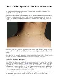 Check spelling or type a new query. What Is Skin Tag Removal And How To Remove It