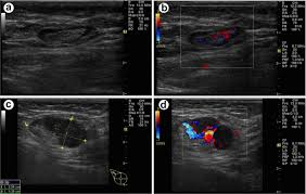 A computer creates a picture based on these waves on a monitor. Sensitivity Specificity And Accuracy Of Ultrasound In Diagnosis Of Breast Cancer Metastasis To The Axillary Lymph Nodes In Chinese Patients Ultrasound In Medicine And Biology