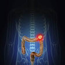 Meaning of colon in english. Illustration Of Colon Cancer In Human Body Silhouette Medicine Medical Stock Photo 243435722