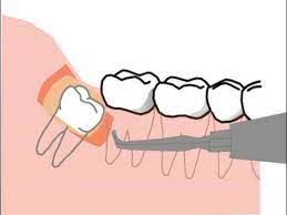 In spite of ecological imbalance following the removal of wolves, the government continued to eradicate them for years to come. Some Special Complications And Risks Of Wisdom Tooth Extraction A Bloodless Cartoon Youtube