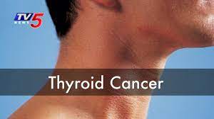 The cells also lose the ability to die, as normal cells would. Thyroid Cancer Causes Symptoms Treatments Colonoscopy Tv5 News Youtube