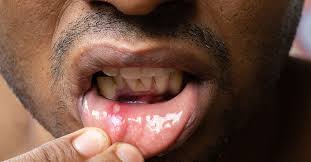 Image result for Mouth ulcers roof of mouth
