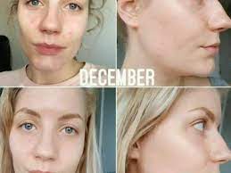 The ordinary peeling solution review (4 weeks). The Ordinary Niacinamide Serum The Ordinary Skin Care Ph