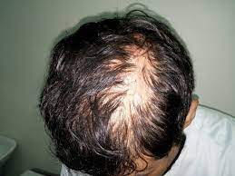 10 Dermatologic Signs Of Celiac Disease Dermatology Advisor