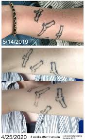 Every session or sitting of tattoo removal can contribute up to a small extent. 8 Weeks After 1 Session With Picosure Going Back For Round 2 Next Week Tattooremoval