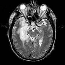 Hse may result from primary infection or reactivation from latency, and it frequently involves frontal or temporal lobes, as well as the brain stem. Herpes Encephalitis T2 Weighted Mr Slice 12