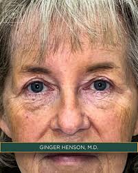 AestheticEye Oculoplastic Surgeons (@aestheticeyemd) • Instagram photos and  videos