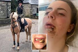 Girl, 15, has her face rebuilt after horse kicked her in the mouth breaking  her jaw and knocking out seven teeth