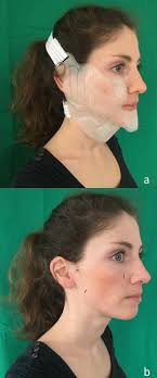 These services attend all types of credit. Evaluation Of The Optimal Cooling Temperature For The Face Measured By The Tissue Perfusion During Hilotherapy Using Laser Doppler Spectrophotometry Scientific Reports