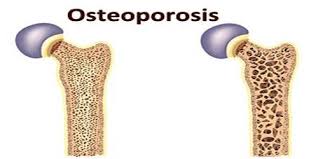 Skip To Content Carsamba Nisan 15 2020 En Guncel Evde Kolay Ekmek Tarifi Metaller Beynimizi Nasil Etkiliyor Kolay Pi Osteoporosis Bone Density Healthy Life