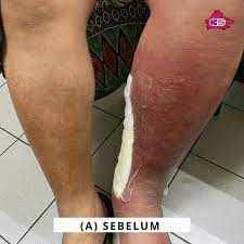 Siapa pun bisa terkena kondisi kulit yang. Penjagaan Kaki Klinik Sabah