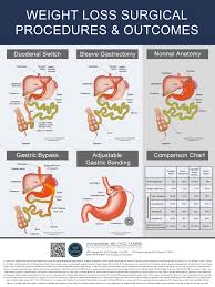 Outcomes Comparison Chart For Surgical Weight Loss