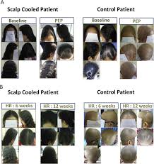 Dealing with chemotherapy hair loss. Randomised Controlled Trial Of Scalp Cooling For The Prevention Of Chemotherapy Induced Alopecia Sciencedirect