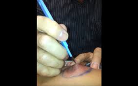 I have caused lots of scarring around my areolas trying to get to the ingrowns. Infected Ingrown Hair Nipple Pimple New Pimple Popping Videos