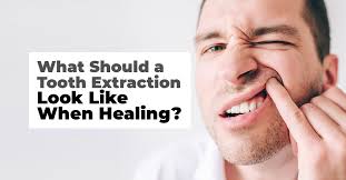 Once the procedure is over, your dentist will send you home to recover. What Should A Tooth Extraction Look Like When It S Healing Rockwest Dental Clinic Mississauga