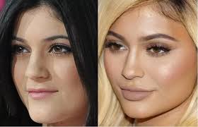 Kylie Jenner Before and After Plastic Surgery