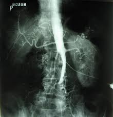 Aortoiliac Occlusive Disease Wikipedia