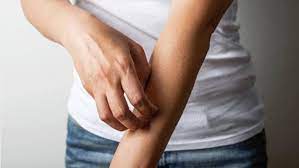 Cara cepat menghilangkan gatal di badan. Jangan Digaruk Ini 6 Jurus Jitu Untuk Mengatasi Kulit Gatal Global Liputan6 Com