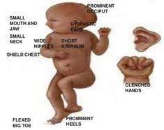 Edward syndrome is also known as trisomy 18. 15 Trisomy 18 Aka Edwards Syndrome Ideas Edwards Syndrome Trisomy 18 Heart Defect