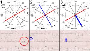 Heart Axis Calculation