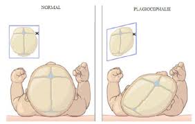 Prendre l'habitude de faire dormir les bébés sur le dos a permis de diminuer de moitié le revers de la médaille, cette mesure est à l'origine d'une augmentation des plagiocéphalies positionnelles. Votre Bebe A La Tete Plate Et Si C Etait Une Plagiocephalie Reflex Osteo