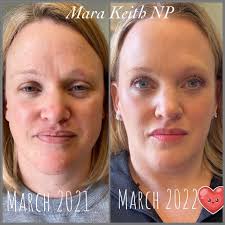 Mara Keith, Nurse Practitioner Injector