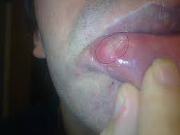 Dezember 2017 was tun gegen aphten? Noch Ne Frage Wegen Aphten Hygiene Mund