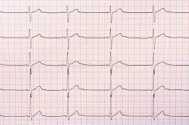 Heart Rhythm Chart Stock Image Image Of Medical Cardiology