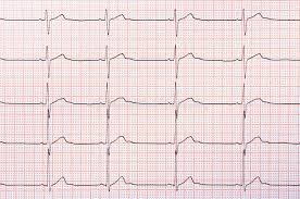 Heart Rhythm Chart Stock Image Image Of Medical Cardiology