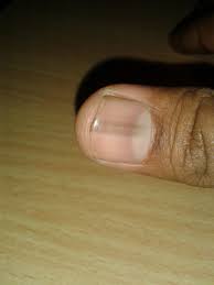 Splinter hemorrhages appear as small black or deep red lines and are caused by injuries to the small blood vessels under the nail beds. Causes Of Black Lines On Nails Nailstip