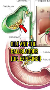 Image result for Biliary Colic