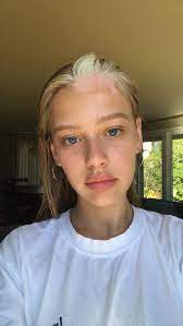 Meet The Rihanna Approved Model Who Wears Her Vitiligo With Pride Vitiligo Tia Jonsson Beauty