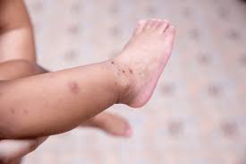 Image result for Hand foot and mouth disease HFMD roof of mouth