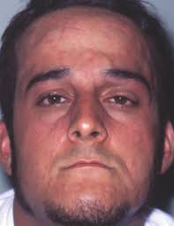Hives on face can develop anywhere on face, including eyes, ears, scalp and neck. Urticaria Associated With Welding Consultant360