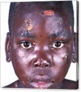 Aids Boy With Impetigo by Science Photo Library