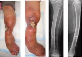 Image result for Osteomyelitis