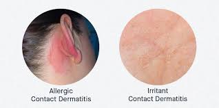 Image result for Contact Dermatitis