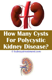 Kidney Stones Passing Polycystic Kidney Disease Kidney Disease Stages Polycystic Kidneys