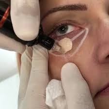 If you have noticed dark circles under your eyes when you look in the mirror, we have some tips for you. Yahoo New Tattoo Method Conceals Dark Circles Under Eyes Permanently Facebook