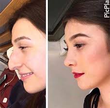However, it is fairly uncommon in a nose job is a safe and effective solution which when performed by a skilled and experienced. Possibly The Best Nose Job I Ve Ever Seen Nose Job Nose Surgery Rhinoplasty Nose Surgery