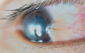 Only awareness of the signs will prompt the parent to seek help. Signs And Symptoms Of Eye Cancer