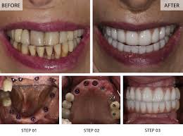 Full Mouth Rehabilitation